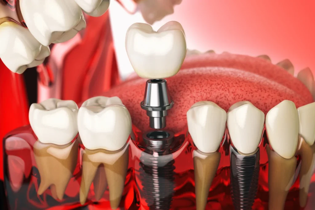Dental-Implants.webp