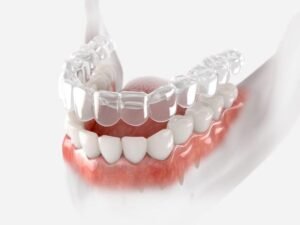 Clear Aligners