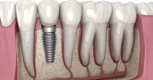 Dental Implants