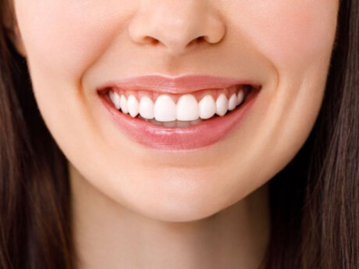 Teeth Whitening