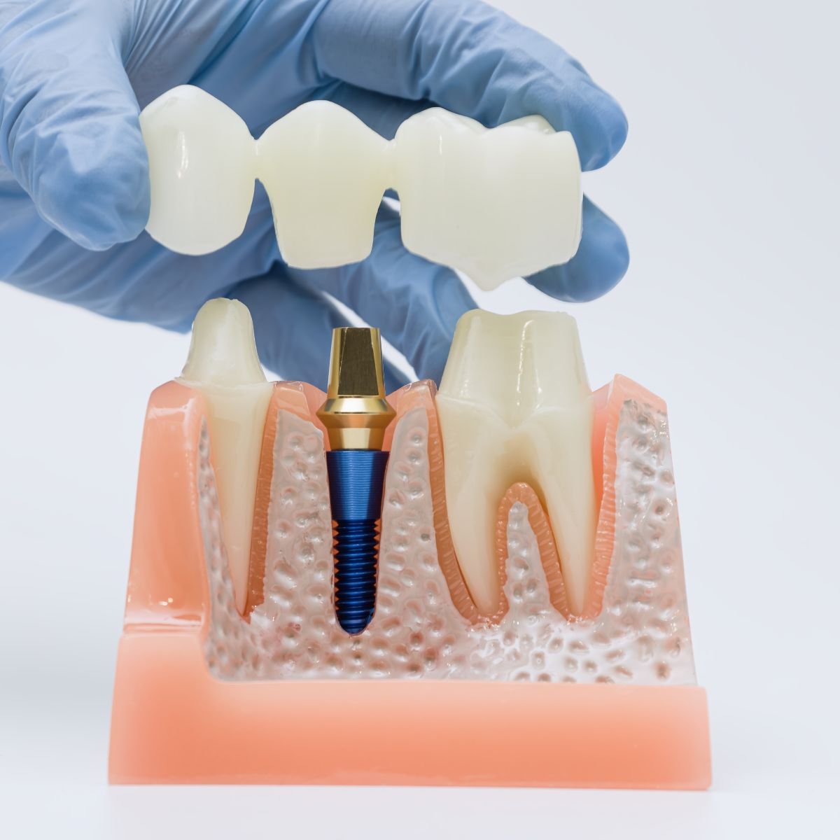 Single dental implant in park ridge