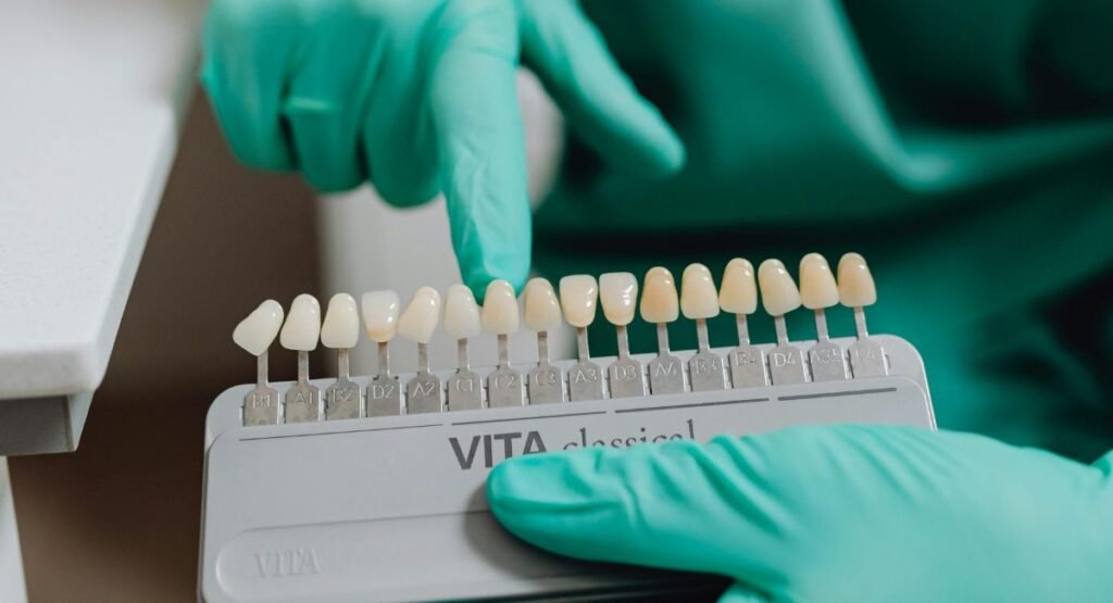 Dental Veneers