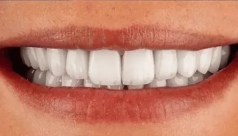 Cosmetic Crowns After