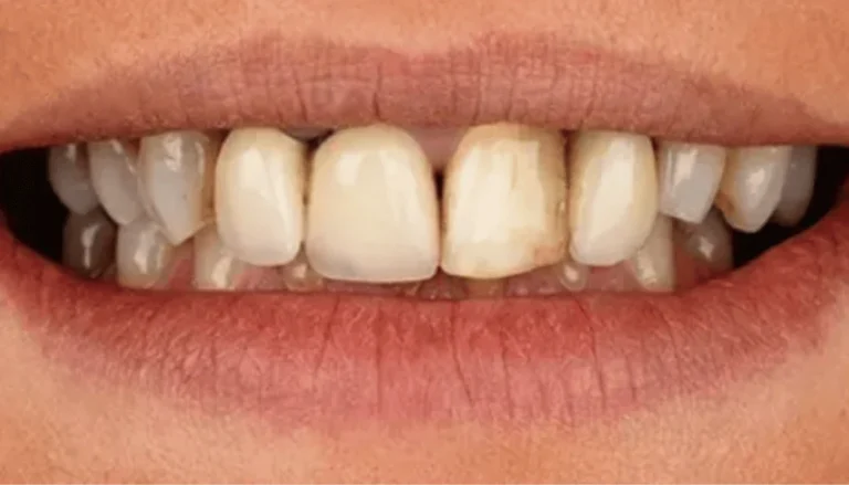 Cosmetic Crowns Before