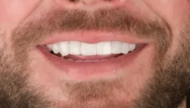 Dental Implants for Front Incisor 2 After