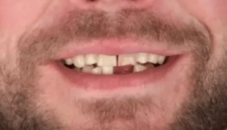 Dental Implants for Front Incisor 2 Before