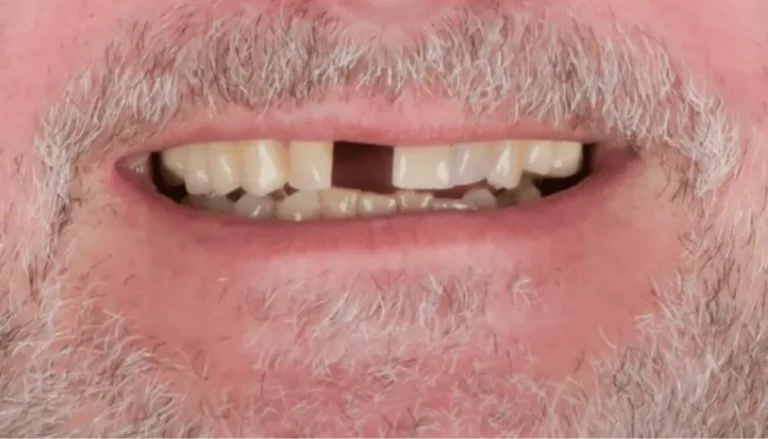 Dental Implants for Front Incisor Before