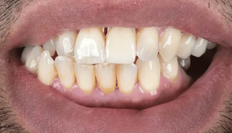 Dental Implants for Pre-Molar After