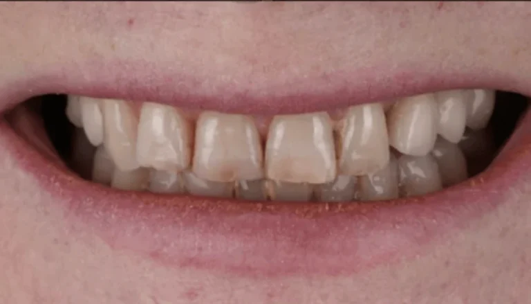 Spark Aligners (Invisalign) After