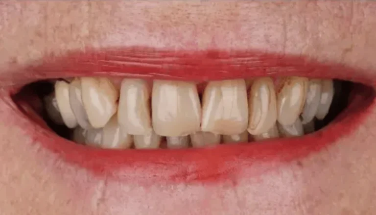 Spark Aligners (Invisalign) Before