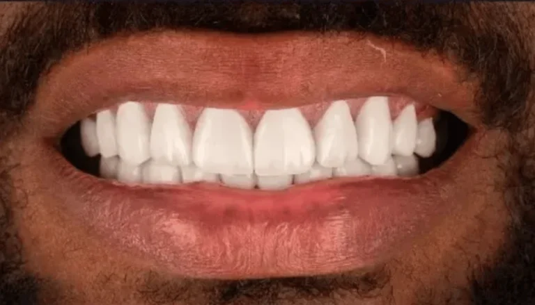 Spark Aligners (Invisalign) & Veneers 2 After