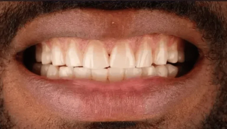 Spark Aligners (Invisalign) & Veneers 2 Before