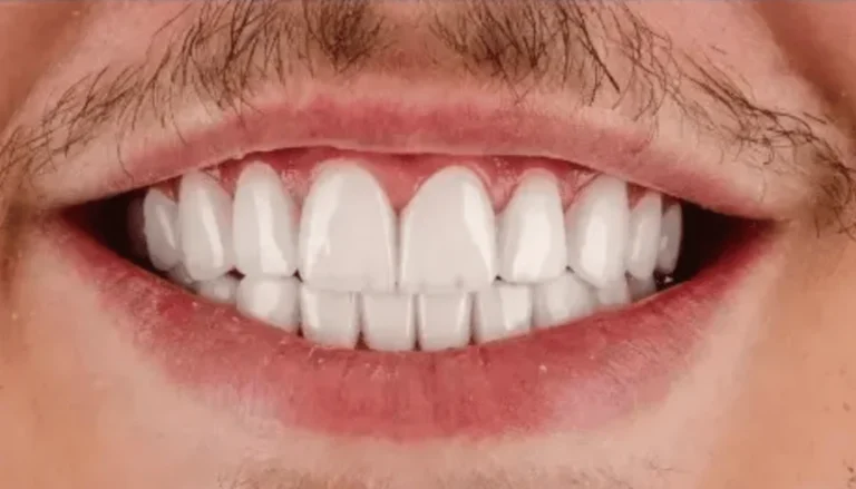 Spark Aligners (Invisalign) & Veneers After