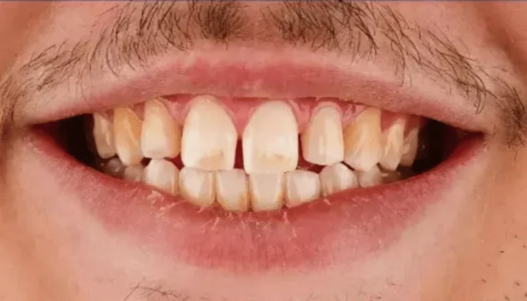 Spark Aligners (Invisalign) & Veneers Before