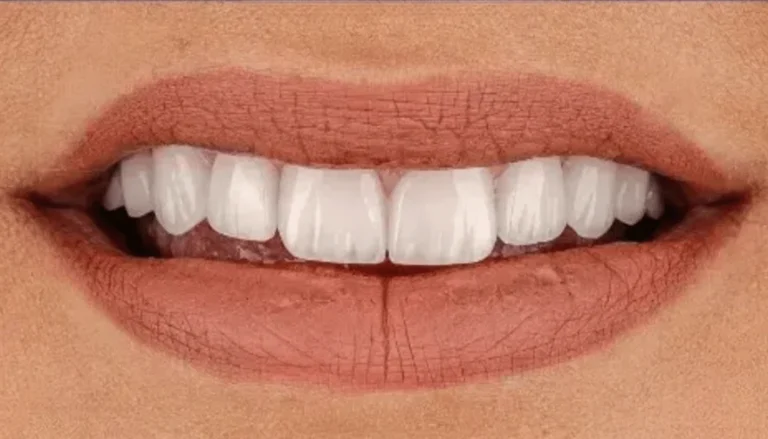 Spark Aligners (Invisalign) & Whitening 3 After