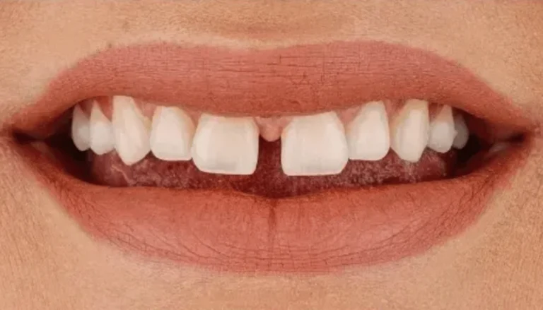 Spark Aligners (Invisalign) & Whitening 3 Before