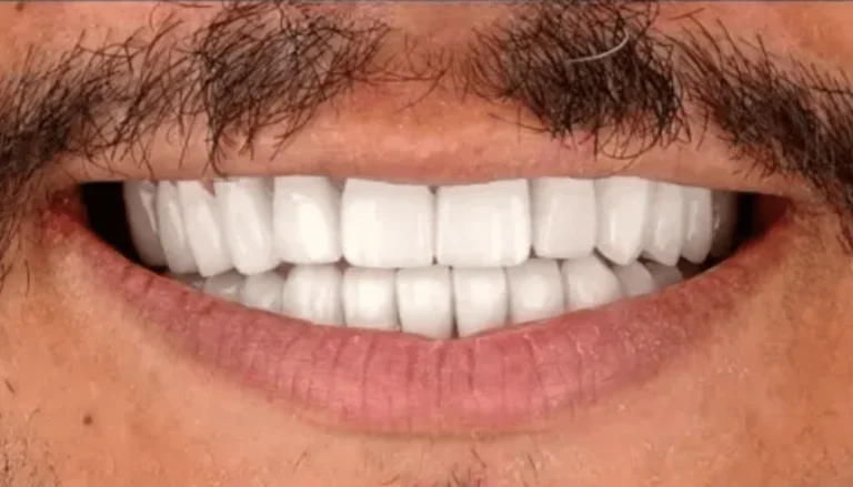 Upper Anterior Bridge Work and Whitening After