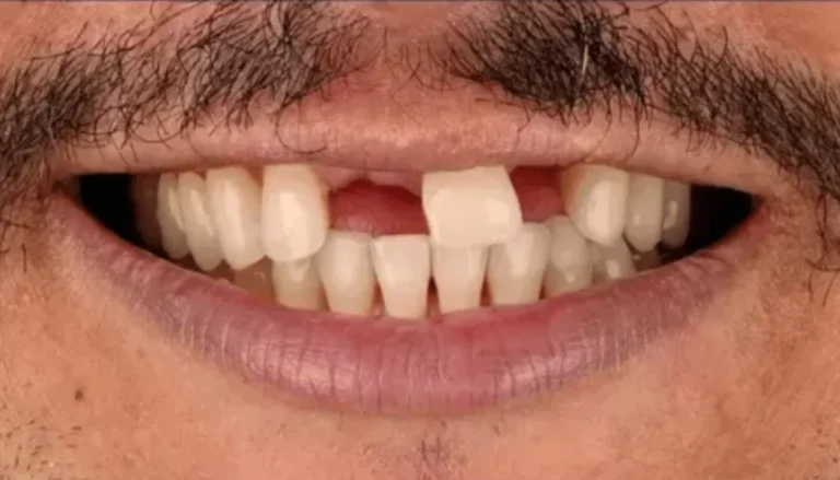 Upper Anterior Bridge Work and Whitening Before