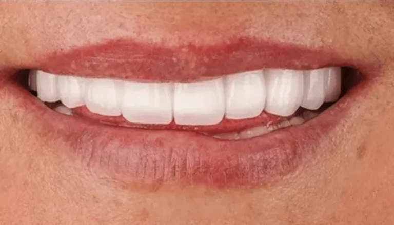Upper & Lower Dentures After
