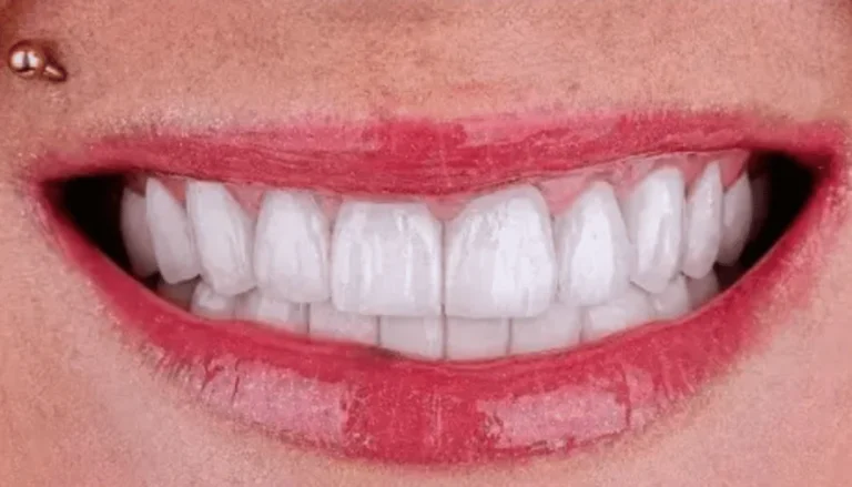 Veneers & Whitening After