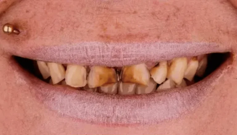 Veneers & Whitening Before