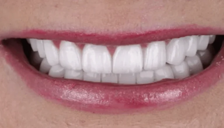 Whitening After