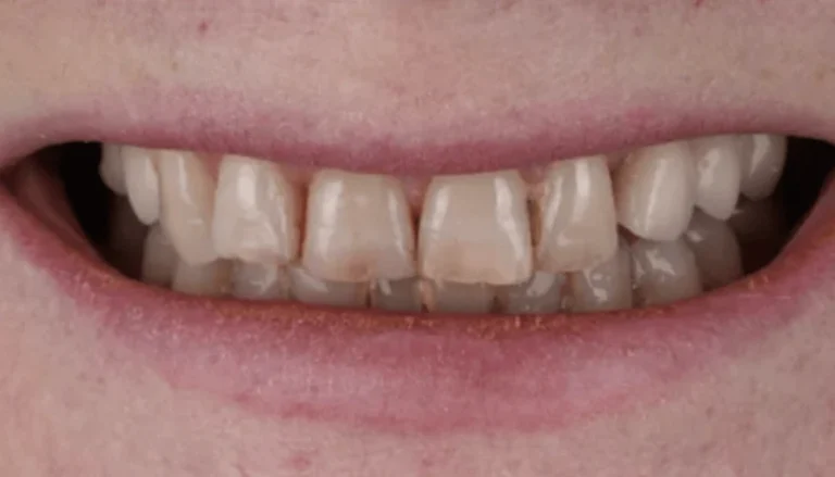 Whitening Before