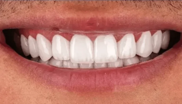 Whitening & Interior Crown Placement After