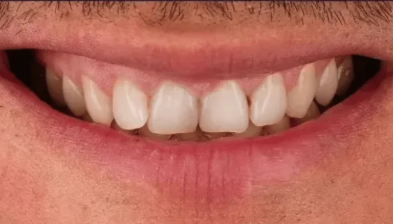 Whitening & Interior Crown Placement Before